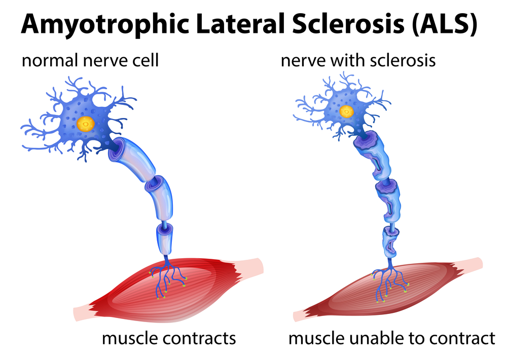 Amyotrophic lateral sclerosis illustration